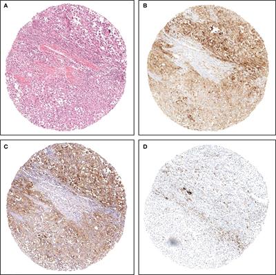 Comparison of three validated PD-L1 immunohistochemical assays in urothelial carcinoma of the bladder: interchangeability and issues related to patient selection